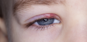 How to Get Rid of a Stye on Eyelid