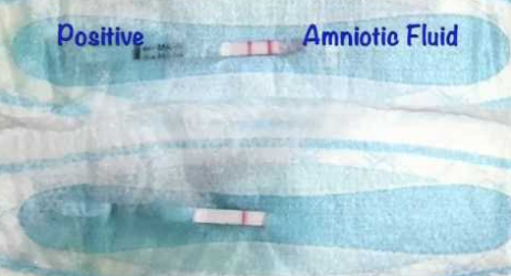 treatment for leaking amniotic fluid