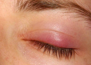 Picture of Stye