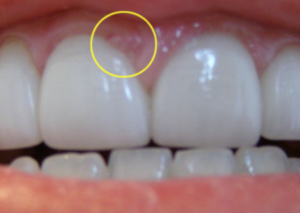 Pimple on Gum above Tooth