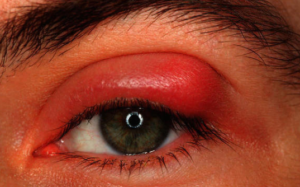 Stye on Eyelid Treatment - Picture