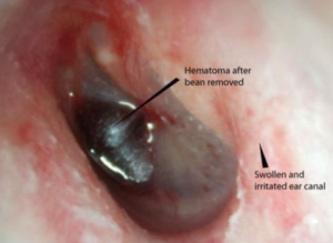 Swollen Ear Canal: Causes , Pictures, Symptoms, Infection, Treatment