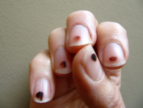 Black Spots On Nails Causes Under Fingernails Dots Tiny Lines On 