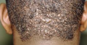 Ingrown Hair on Scalp Picture