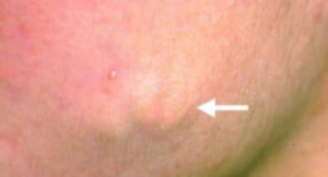 A lump on Inner Thigh