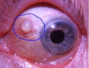 Picture of Small Lump on Eyeball