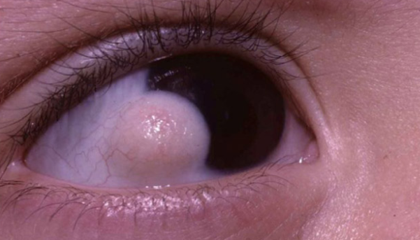eyeball hurts to touch and blink