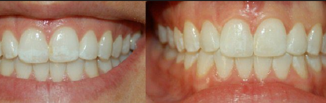 teeth spots rid causes child treatment adults