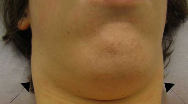 Lump Under Chin Causes Right Or Left Side Near Throat Neck 