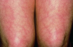 mottled skin causes before death