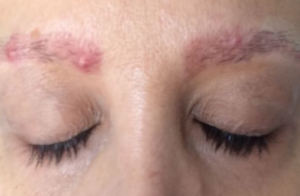 Pimples on Eyebrows after Waxing or Threading