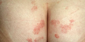 Rash on buttocks crack