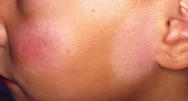 What Causes Light Patches On Skin