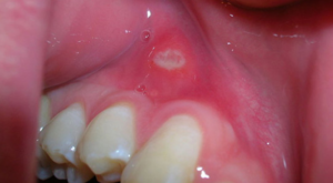 White Spots on Gums