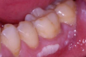 White Spots on Gums Pictures