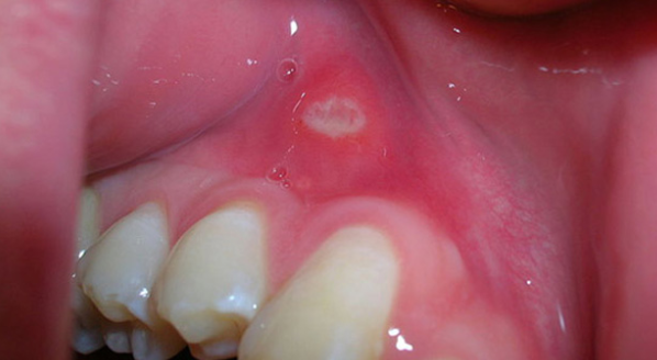 white-spot-on-gums-causes-pictures-painful-above-tooth-under-tooth