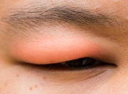 A Picture of Swollen Eyelid