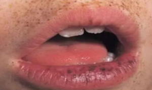 Black Spots on Lips and around Mouth
