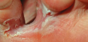 Causes of skin Peeling between Toes