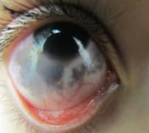 Dark Spots on Eyeball