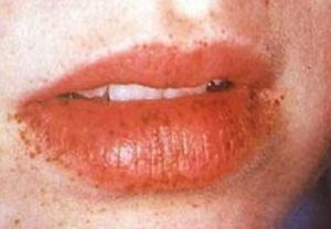 Dark spots on lips picture