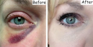 How to Get Rid of a Black Eye with Home Remedies