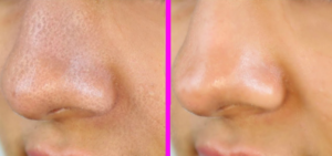 How to Shrink Large Pores on Nose- Before & After Picture