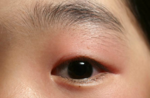 How to Treat a Swollen Eyelid