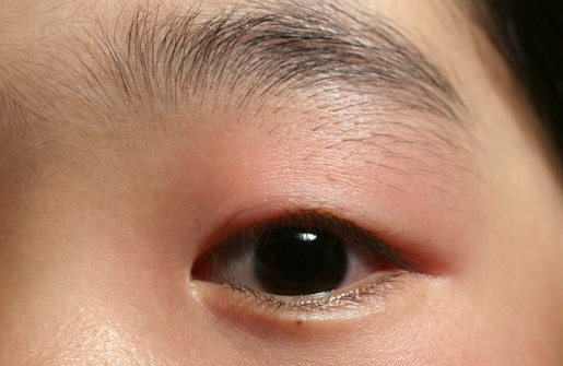 Swollen Eyelids: Causes, Pictures, Meaning, How to Get Rid, Cure, Treatment