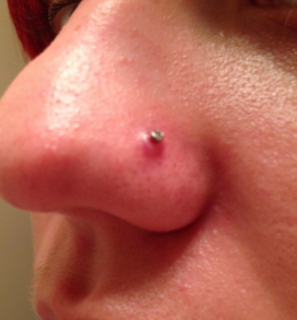 Nose Piercing Bump Image
