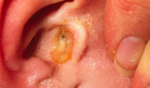 Otitis Media can also cause Swelling in the Ear Canal
