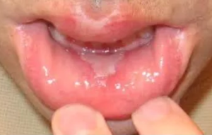 Peeling Inside of Mouth Picture