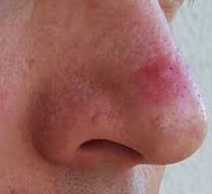 Red Patches or Spots on Nose