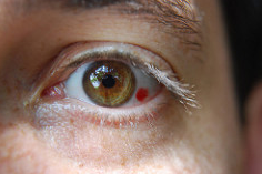 Red Spot on Eyeball Picture