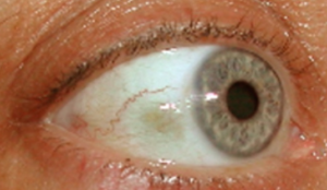 Spots on Eyeball