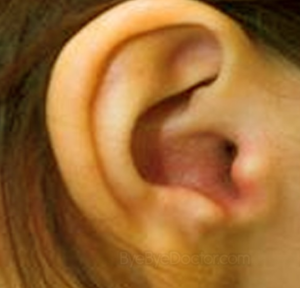 Swollen Ear Canal from Infection - Picture