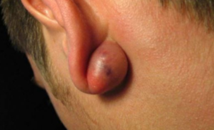 Swollen Ear Lobe Picture