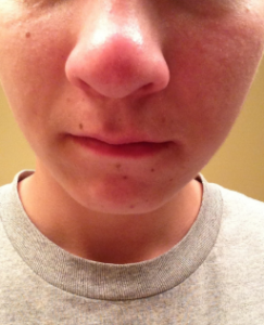 Swollen Nose Causes
