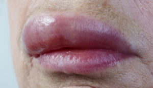 Swollen upper Lips