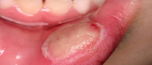 What Causes Inside of Mouth to Peeling