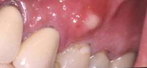 White Pimple on Gum