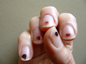 Black Spots on Fingernails