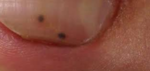 Black Spots on Nails Picture