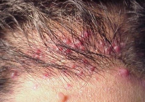 Ingrown Hair on Scalp: Pictures, Causes, Symptoms ...