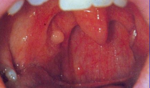 A Picture of Tonsil Cyst