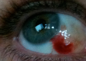 Blood Blister in Eyeball