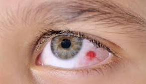 Blood Blister on Eyeball