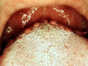 Bumps on Back of Tongue could be Oral Thrush