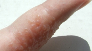 Bumps on Fingers Dyshidrotic Eczema - Pictures