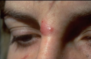 Cyst on Nose -Image